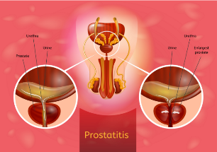 prostatīts