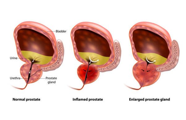 prostatīts ir prostatas dziedzera iekaisums