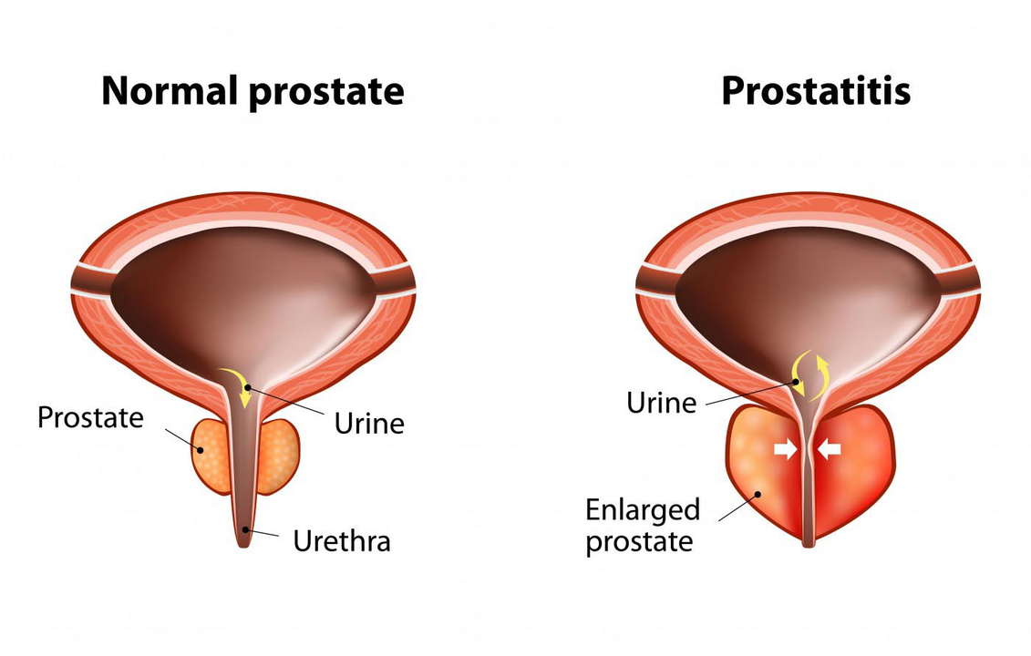 Vesela vīrieša normāla prostata un prostatas dziedzera iekaisums ar prostatītu